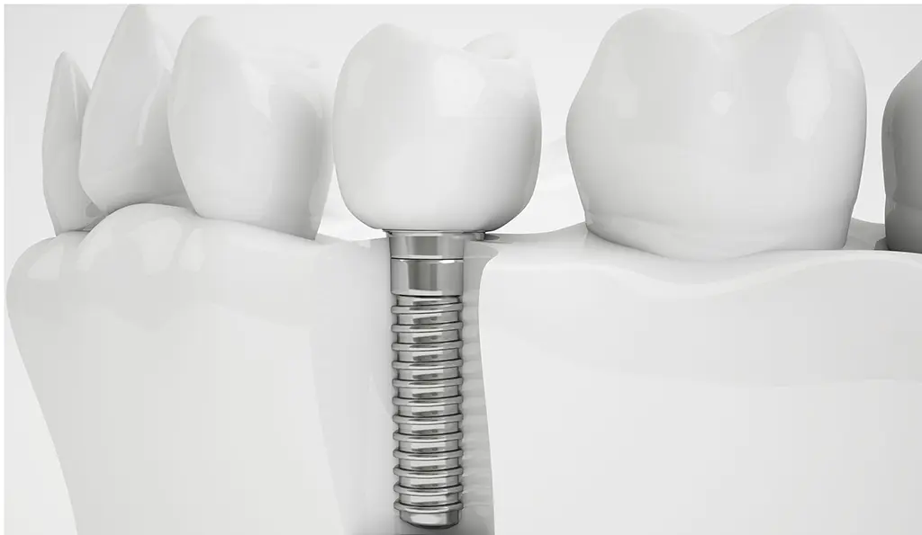 dental implant screw and white crown on white background